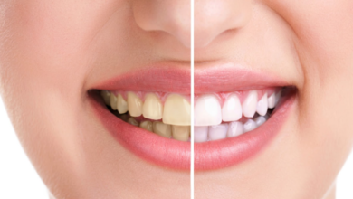 Teeth Whitening to Veneers