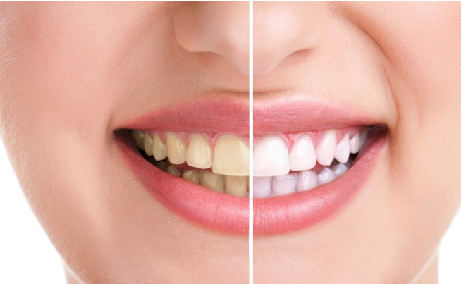 Teeth Whitening to Veneers